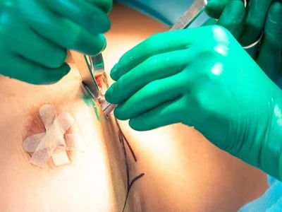 Die häufigsten Fragen zur Brustvergrößerung mit Straffung beantwortet
